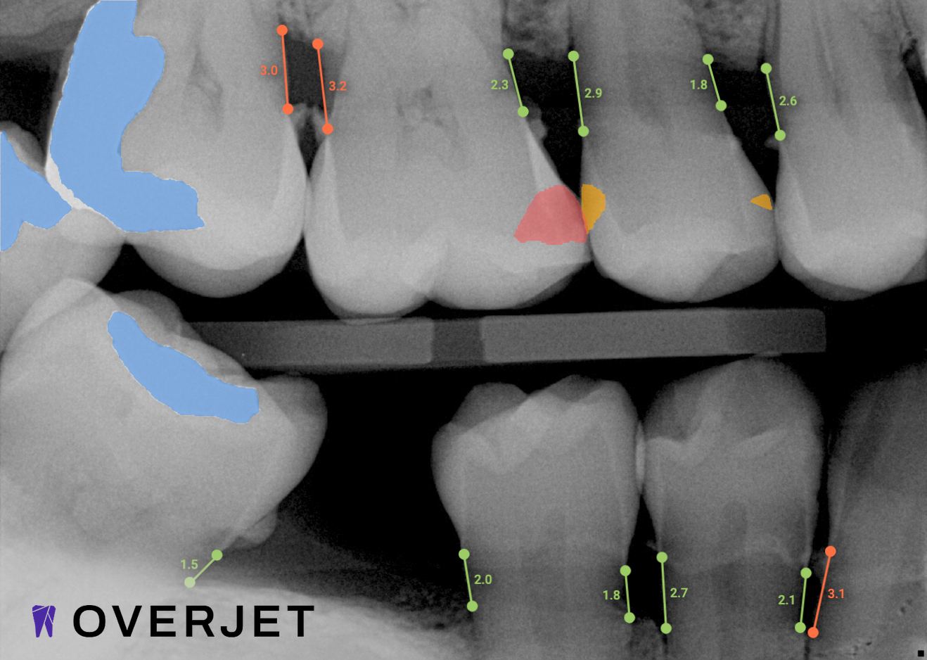 overjet1